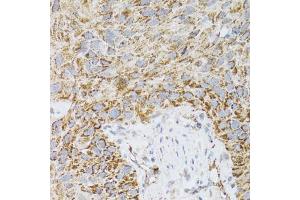 Immunohistochemistry of paraffin-embedded human lung cancer using PDYN antibody (ABIN2564462) at dilution of 1:100 (40x lens). (PDYN 抗体)