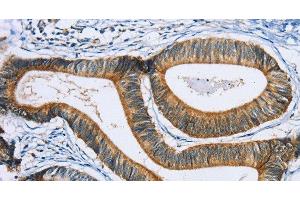 Immunohistochemistry of paraffin-embedded Human colon cancer using SULT1B1 Polyclonal Antibody at dilution of 1:30 (SULT1B1 抗体)