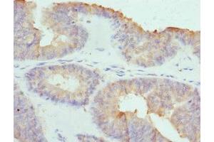 Immunohistochemistry of paraffin-embedded human endometrial cancer using ABIN7148039 at dilution of 1:100 (COCH 抗体  (AA 20-260))