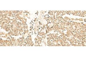 Immunohistochemistry of paraffin-embedded Human lung cancer tissue using TBPL1 Polyclonal Antibody at dilution of 1:50(x200) (TBPL1 抗体)