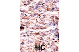 Formalin-fixed and paraffin-embedded human cancer tissue reacted with the primary antibody, which was peroxidase-conjugated to the secondary antibody, followed by AEC staining. (PSKH1 抗体  (N-Term))