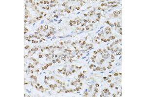 Immunohistochemistry of paraffin-embedded human colon carcinoma using SATB1 antibody. (SATB1 抗体)