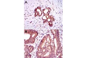 Immunohistochemical analysis of paraffin-embedded human prostate tissue (A) and colon cancer tissue (B) using OTX2 monoclonal antobody, clone 1H12C4B5  with DAB staining. (OTX2 抗体)