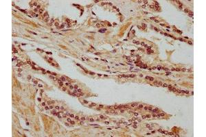 IHC image of ABIN7168592 diluted at 1:400 and staining in paraffin-embedded human prostate cancer performed on a Leica BondTM system. (SAGE1 抗体  (AA 3-133))