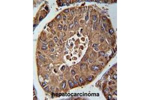 ACN9 Antibody (N-term) immunohistochemistry analysis in formalin fixed and paraffin embedded human hepatocarcinoma followed by peroxidase conjugation of the secondary antibody and DAB staining. (ACN9 抗体  (N-Term))
