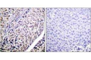 Immunohistochemistry analysis of paraffin-embedded human liver carcinoma tissue, using AurB (Ab-12) Antibody. (Aurora Kinase B 抗体  (AA 1-50))