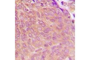 Immunohistochemical analysis of PPP2CA staining in human breast cancer formalin fixed paraffin embedded tissue section. (PPP2CA 抗体  (C-Term))