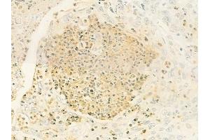 ABIN6264758 and ABIN6279799 at 1/100 staining human esophageal carcinoma by IHC-P. (RIOK1 抗体  (C-Term))
