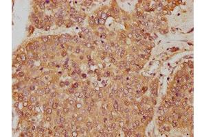 IHC image of ABIN7144729 diluted at 1:250 and staining in paraffin-embedded human liver cancer performed on a Leica BondTM system. (GOT1 抗体  (AA 2-411))