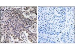 Immunohistochemistry analysis of paraffin-embedded human lung carcinoma tissue, using MRPL54 Antibody. (MRPL54 抗体  (AA 81-130))