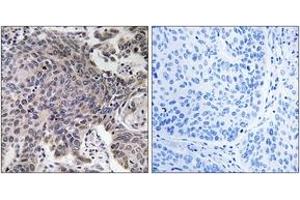 Immunohistochemistry analysis of paraffin-embedded human lung carcinoma tissue, using MRPL54 Antibody. (MRPL54 抗体  (AA 81-130))