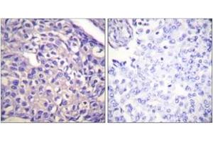 Immunohistochemistry analysis of paraffin-embedded human breast carcinoma tissue, using MYPT1 (Ab-696) Antibody. (PPP1R12A 抗体  (AA 661-710))