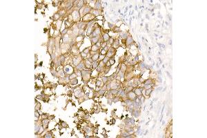 Immunohistochemistry of paraffin-embedded Human lung squamous carcinoma tissue using TROP-2 antibody (ABIN7271103) at dilution of 1:2700 (40x lens). (TACSTD2 抗体)