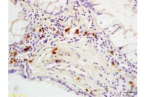 Formalin-fixed and paraffin embedded human colon carcinoma labeled with Rabbit Anti phospho-p53BP1(Ser25/29) Polyclonal Antibody, Unconjugated (ABIN682993) at 1:200 followed by conjugation to the secondary antibody and DAB staining (TP53BP1 抗体  (pSer25, pSer29))