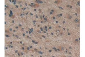 Detection of dSIP in Human Glioma Tissue using Polyclonal Antibody to Delta-Sleep Inducing Peptide (dSIP) (dSIP (AA 1-134) 抗体)