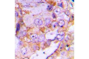 Immunohistochemical analysis of 4EBP1 staining in human lung cancer formalin fixed paraffin embedded tissue section. (eIF4EBP1 抗体  (N-Term))