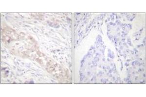 Immunohistochemistry analysis of paraffin-embedded human breast carcinoma, using Smad2 (Phospho-Ser467) Antibody. (SMAD2 抗体  (pSer467))