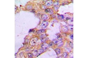 Immunohistochemical analysis of COX5B staining in human lung cancer formalin fixed paraffin embedded tissue section. (COX5B 抗体  (N-Term))