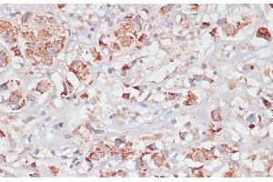 Immunohistochemistry of paraffin-embedded Human breast cancer using Desmoplakin Polyclonal Antibody at dilution of 1:100 (40x lens). (Desmoplakin 抗体)