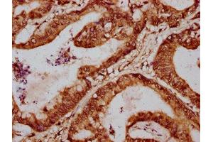 IHC image of ABIN7155055 diluted at 1:700 and staining in paraffin-embedded human colon cancer performed on a Leica BondTM system. (FOXA3 抗体  (AA 220-336))
