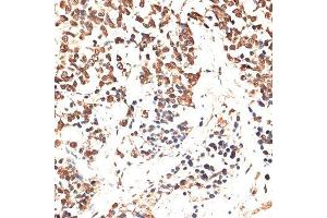 Immunohistochemistry of paraffin-embedded human lung cancer using MCM5 antibody. (MCM5 抗体  (AA 1-230))