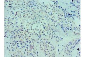 Immunohistochemistry of paraffin-embedded human breast cancer using ABIN7158577 at dilution of 1:100 (LRP6 抗体  (AA 20-150))