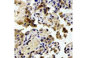 Immunohistochemical analysis of RPS20 staining in human lung cancer formalin fixed paraffin embedded tissue section. (RPS20 抗体)