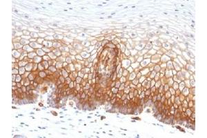 IHC testing of FFPE human cervical carcinoma with Thrombomodulin antibody (clone THBD/1591). (Thrombomodulin 抗体  (AA 69-194))