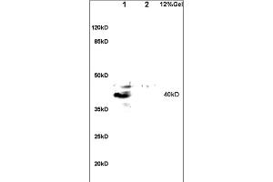 Formalin-fixed and paraffin embedded human lung carcinoma labeled with Anti-GPR15 Polyclonal Antibody, Unconjugated (ABIN702835) at 1:200 followed by conjugation to the secondary antibody and DAB staining. (GPR15 抗体  (AA 51-150))