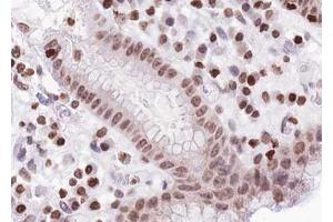 ABIN6267628 at 1/100 staining human Stomach carcinoma tissue sections by IHC-P. (FOXO1/3/4-pan 抗体  (pThr24, pThr32))