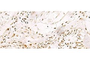 Immunohistochemistry of paraffin-embedded Human lung cancer tissue using PDS5A Polyclonal Antibody at dilution of 1:90(x200) (PDS5A 抗体)