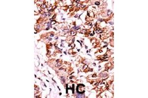 Formalin-fixed and paraffin-embedded human hepatocellular carcinoma tissue reacted with CHEK1 (phospho S317) polyclonal antibody  which was peroxidase-conjugated to the secondary antibody followed by AEC staining.