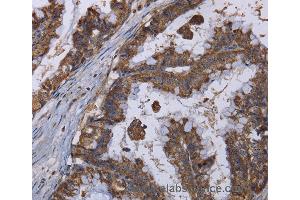Immunohistochemistry of Human esophagus cancer using MT3 Polyclonal Antibody at dilution of 1:50 (MT3 抗体)