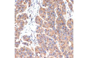 Immunohistochemistry of paraffin-embedded human esophageal cancer using G1 Rabbit mAb (ABIN7265446) at dilution of 1:100 (40x lens). (gamma 1 Adaptin 抗体)
