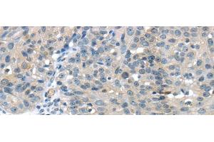 Immunohistochemistry of paraffin-embedded Human breast cancer using GLP2R Polyclonal Antibody at dilution of 1/30 (GLP2R 抗体)