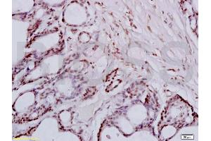 Formalin-fixed and paraffin embedded human colon carcinoma tissue labeled with Anti-FRA2/FOSL2 Polyclonal Antibody, Unconjugated (ABIN673104) at 1:200 followed by conjugation to the secondary antibody and DAB staining (FOSL2 抗体  (AA 231-326))