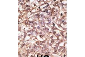 Formalin-fixed and paraffin-embedded human cancer tissue reacted with the primary antibody, which was peroxidase-conjugated to the secondary antibody, followed by DAB staining. (DKK4 抗体  (C-Term))