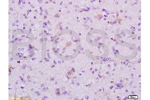 Formalin-fixed and human glioma tissue labeled with Anti-MAP1A Polyclonal Antibody (ABIN735308), Unconjugated at 1:200 followed by conjugation to the secondary antibody and DAB staining (MAP1A 抗体  (AA 2651-2750))