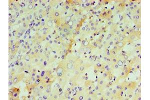 Immunohistochemistry of paraffin-embedded human liver tissue using ABIN7156608 at dilution of 1:100 (IL29 抗体  (AA 21-200))