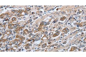 Immunohistochemistry of paraffin-embedded Human gasrtic cancer tissue using SLC34A2 Polyclonal Antibody at dilution of 1:50 (SLC34A2 抗体)