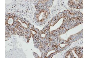 IHC-P Image Immunohistochemical analysis of paraffin-embedded human endo mitral OCVA , using RAB2A, antibody at 1:100 dilution. (RAB2A 抗体  (C-Term))