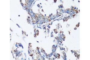 Immunohistochemistry of paraffin-embedded Human gastric cancer using SRC Polyclonal Antibody at dilution of 1:100 (40x lens). (Src 抗体)