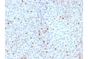 IHC testing of FFPE human bladder carcinoma with Topoisomerase II alpha antibody (clone TOP2A/1361). (Topoisomerase II alpha 抗体  (AA 1352-1493))