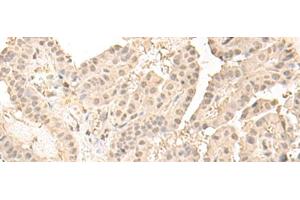Immunohistochemistry of paraffin-embedded Human thyroid cancer tissue using ZGPAT Polyclonal Antibody at dilution of 1:35(x200) (ZGPAT 抗体)