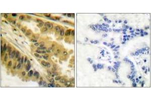 Immunohistochemistry analysis of paraffin-embedded human lung carcinoma tissue, using PKC zeta (Ab-410) Antibody. (PKC zeta 抗体  (AA 376-425))