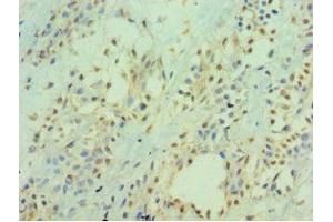 Immunohistochemistry of paraffin-embedded human breast cancer using ABIN7156537 at dilution of 1:100 (ICAM2 抗体  (AA 25-223))