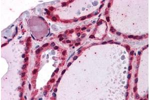 Human Thyroid: Formalin-Fixed, Paraffin-Embedded (FFPE) (IRAK1 抗体  (AA 530-693))