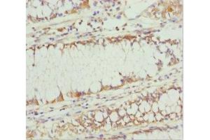 Immunohistochemistry of paraffin-embedded human colon cancer using ABIN7163636 at dilution of 1:100 (PLEKHA1 抗体  (AA 285-404))