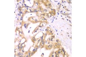 Immunohistochemistry of paraffin-embedded human liver cancer using ACADS antibody. (ACADS 抗体)