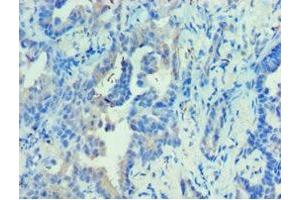 Immunohistochemistry of paraffin-embedded human lung cancer using ABIN7142680 at dilution of 1:100 (PRKAB2 抗体  (AA 1-272))